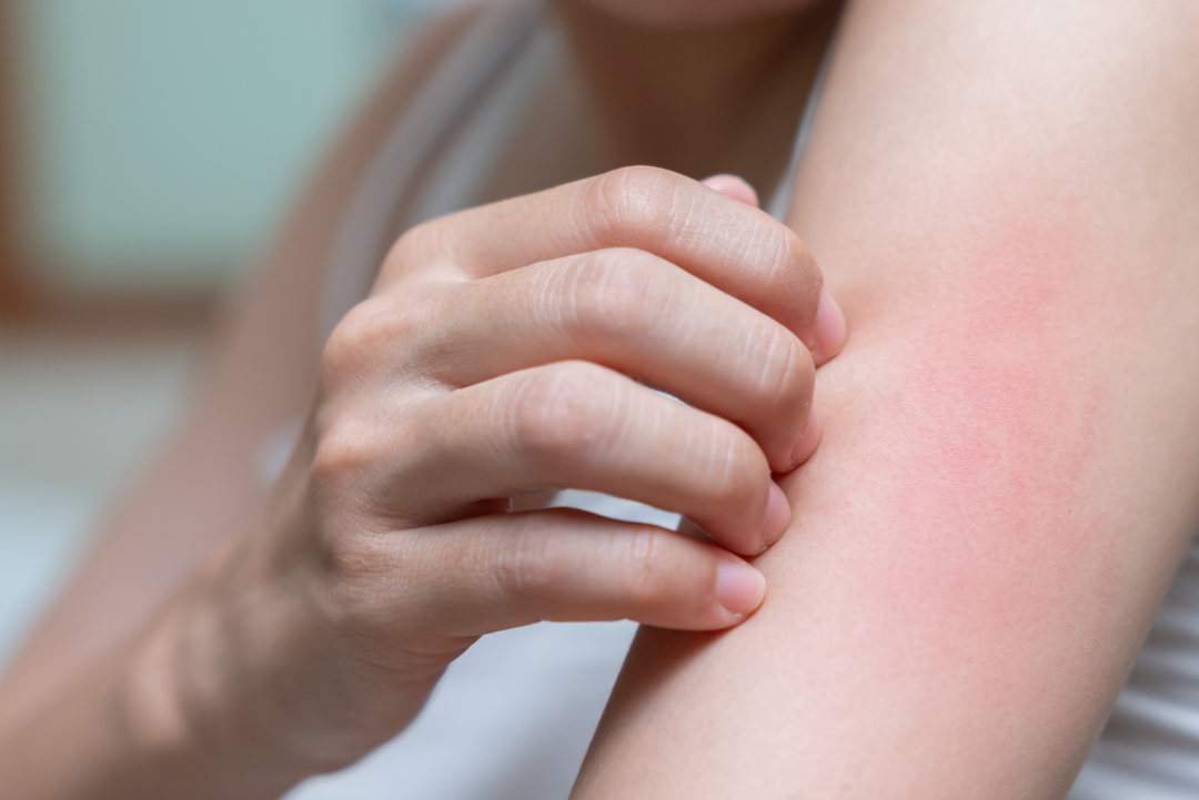 Image of person with red rash on their arm. NoNickel specializes in nickel free products for sensitive skin.