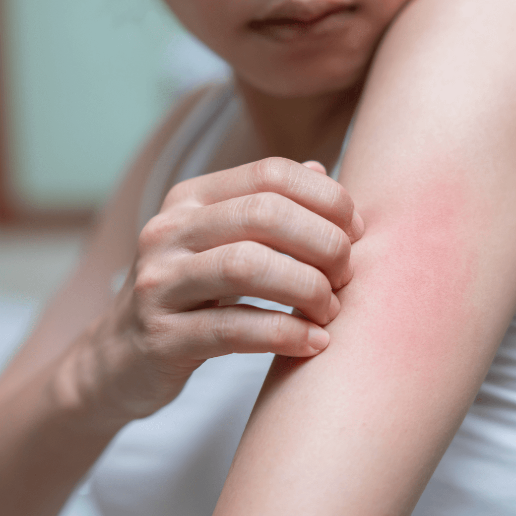 Image of someone with sensitive skin scratching red rash on arm.